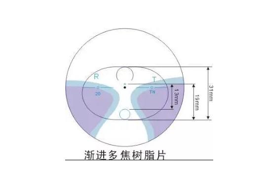 美麗島多焦鏡適合的人群，需要注意的事項(xiàng)